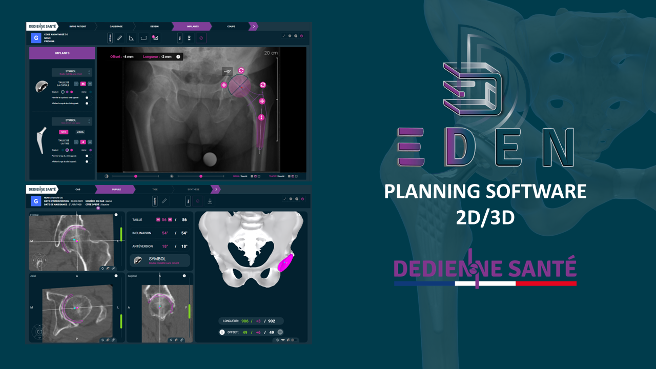 2D/3D preoperative planning solution