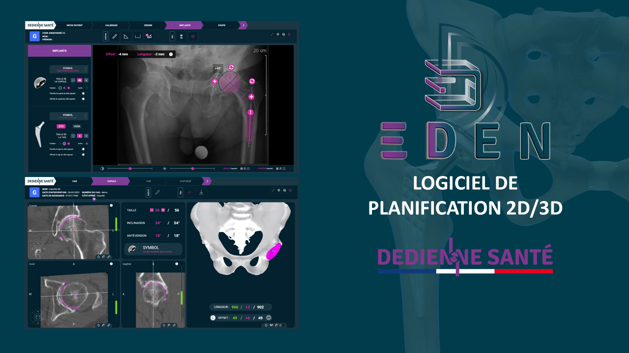 EDEN, la planification pré-opératoire 2D/3D par DEDIENNE SANTÉ